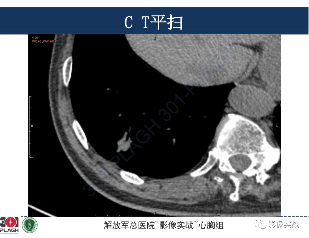 影像PPT - 【病例】肺浸润性腺癌1例CT影像-12