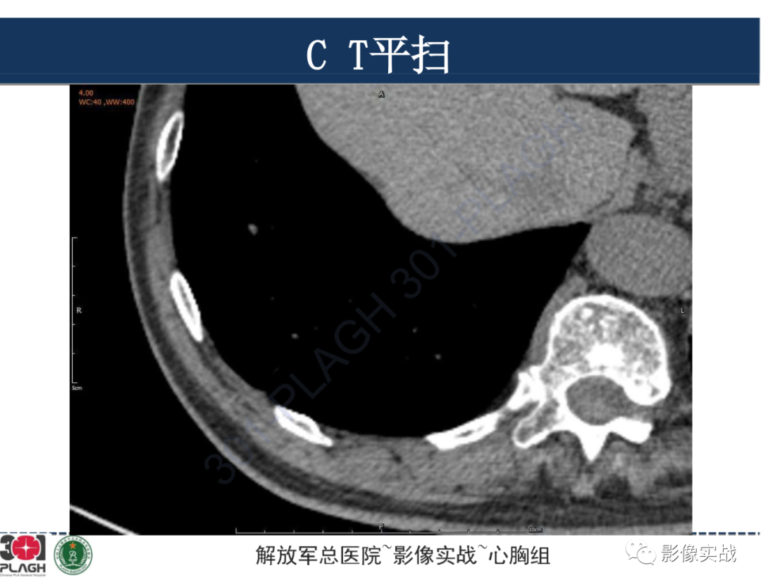 影像PPT - 【病例】肺浸润性腺癌1例CT影像-14