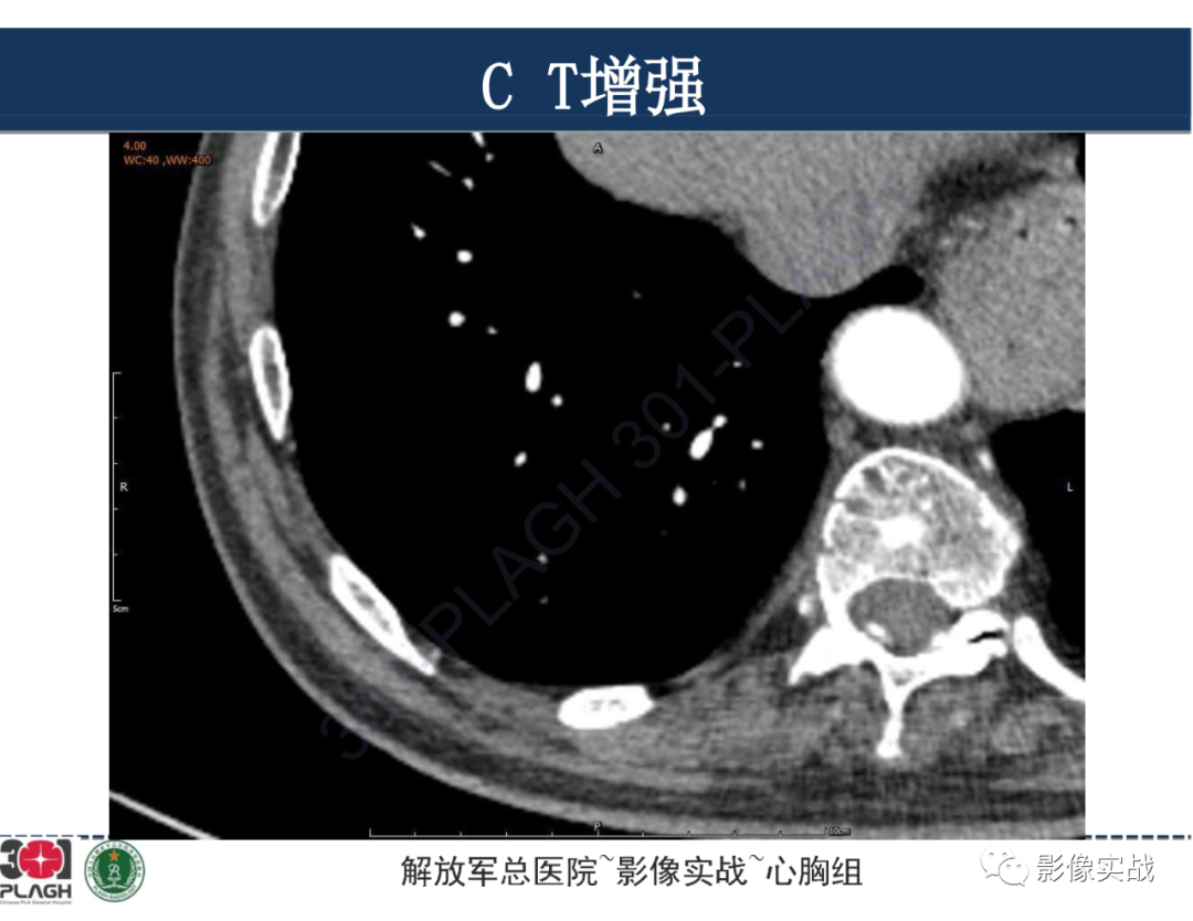影像PPT - 【病例】肺浸润性腺癌1例CT影像-16