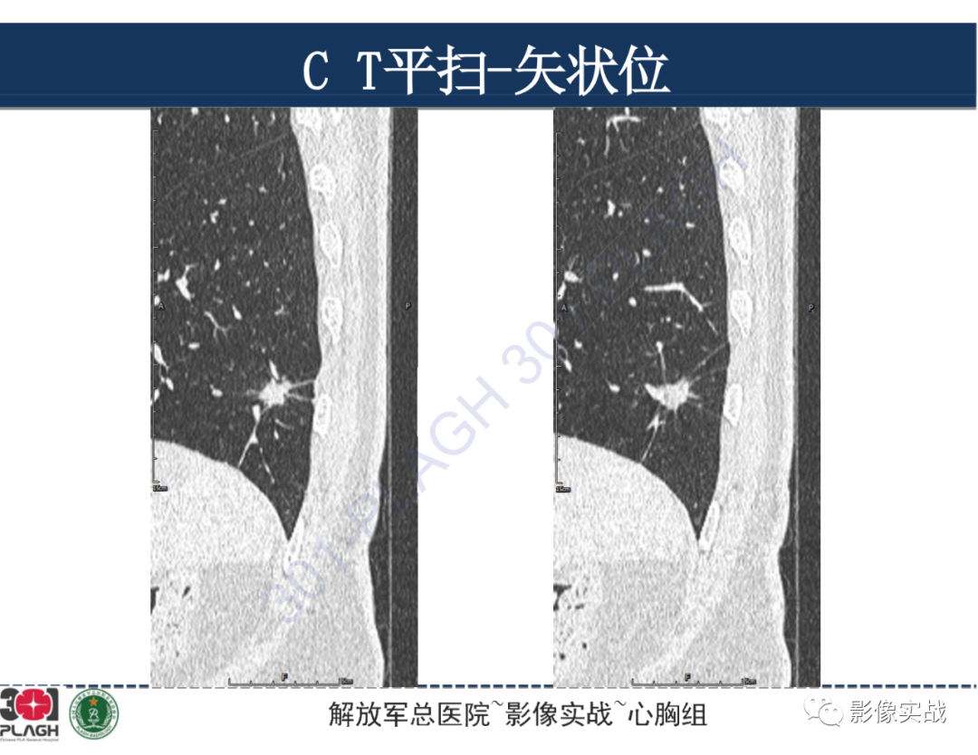 影像PPT - 【病例】肺浸润性腺癌1例CT影像-15
