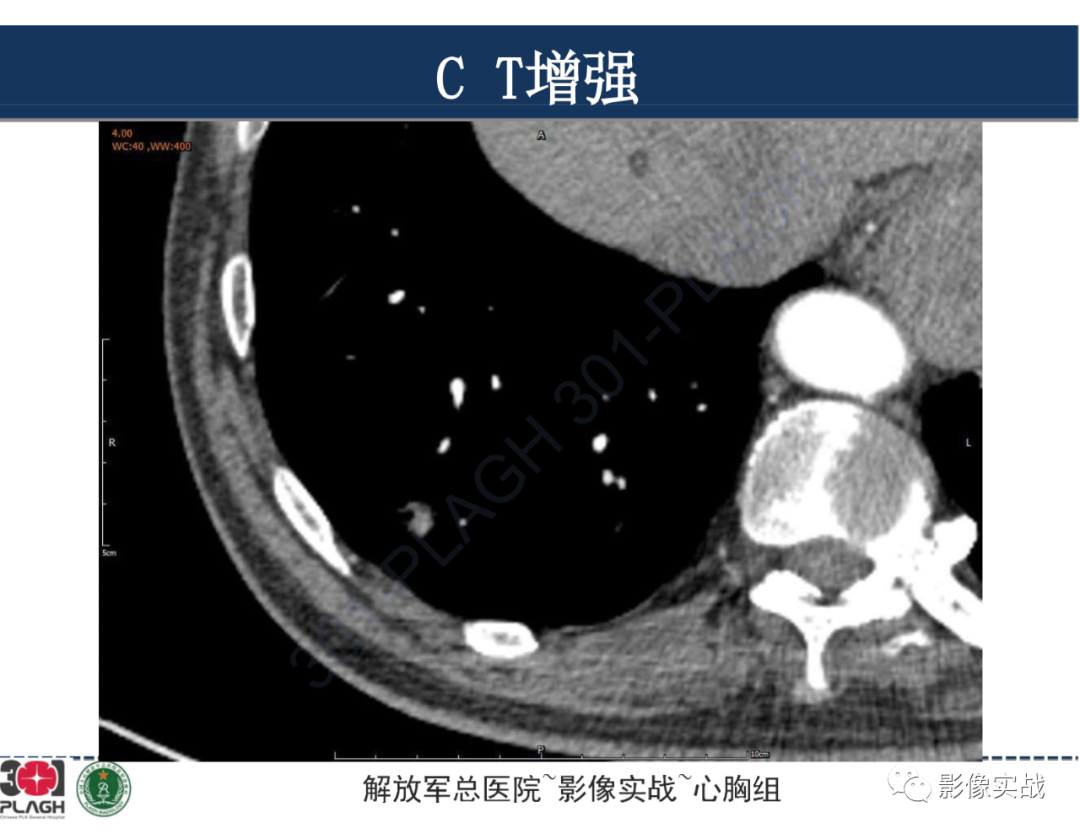 影像PPT - 【病例】肺浸润性腺癌1例CT影像-17