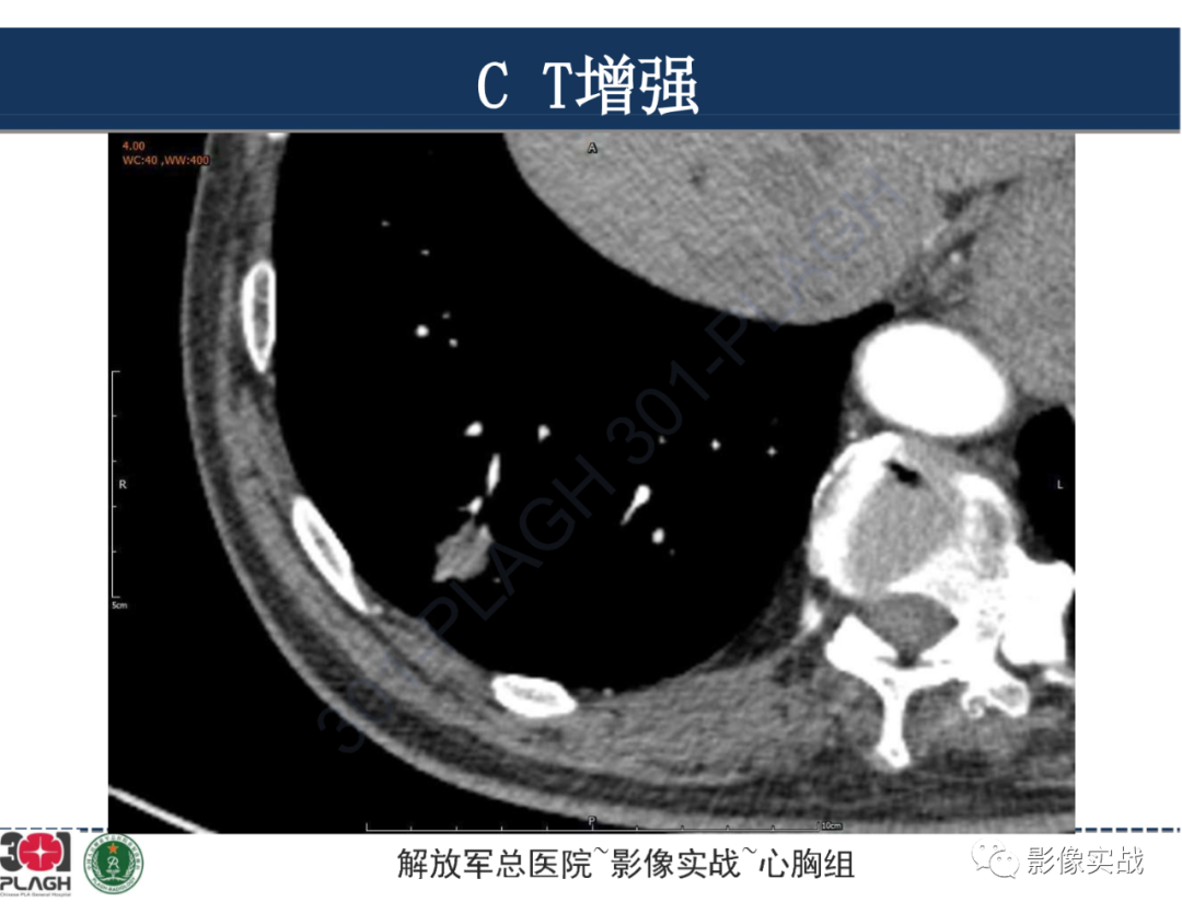 影像PPT - 【病例】肺浸润性腺癌1例CT影像-18