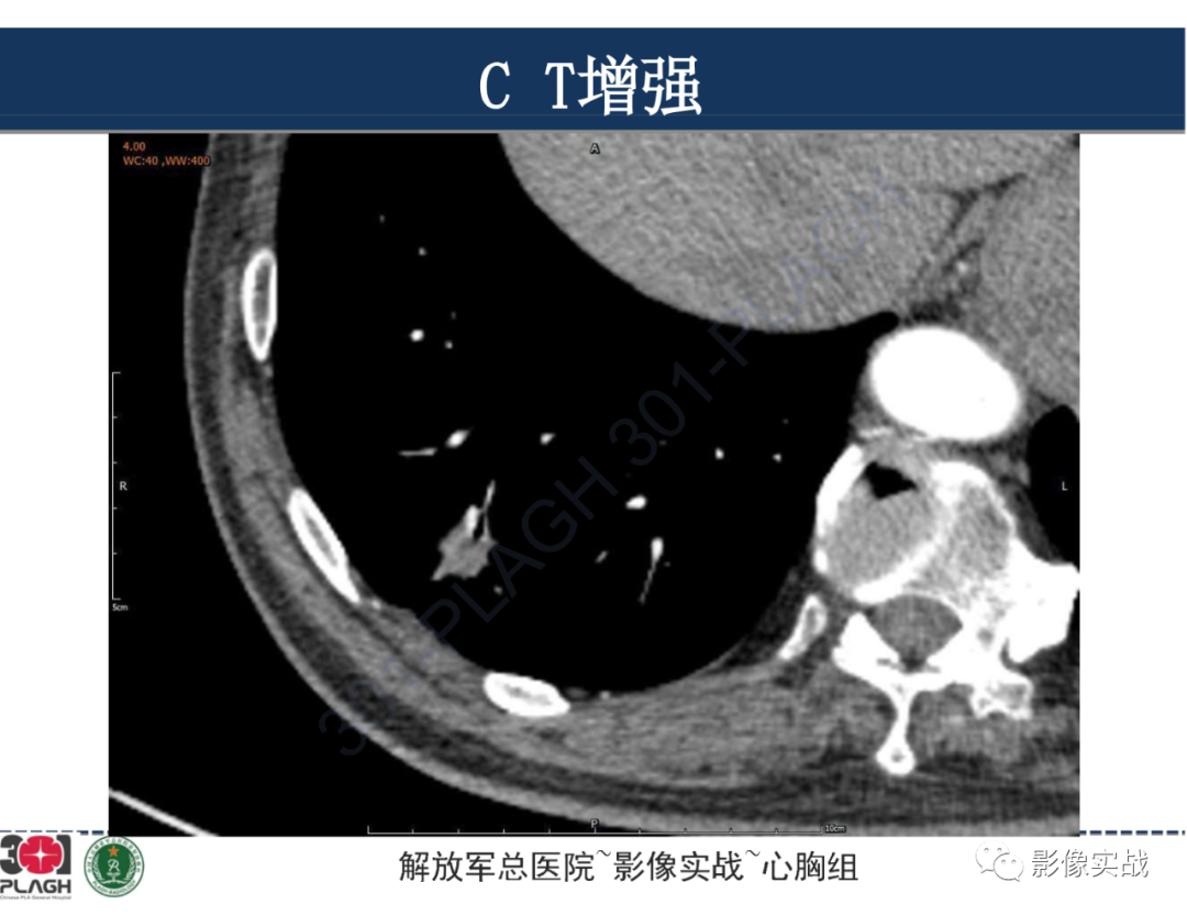 影像PPT - 【病例】肺浸润性腺癌1例CT影像-19