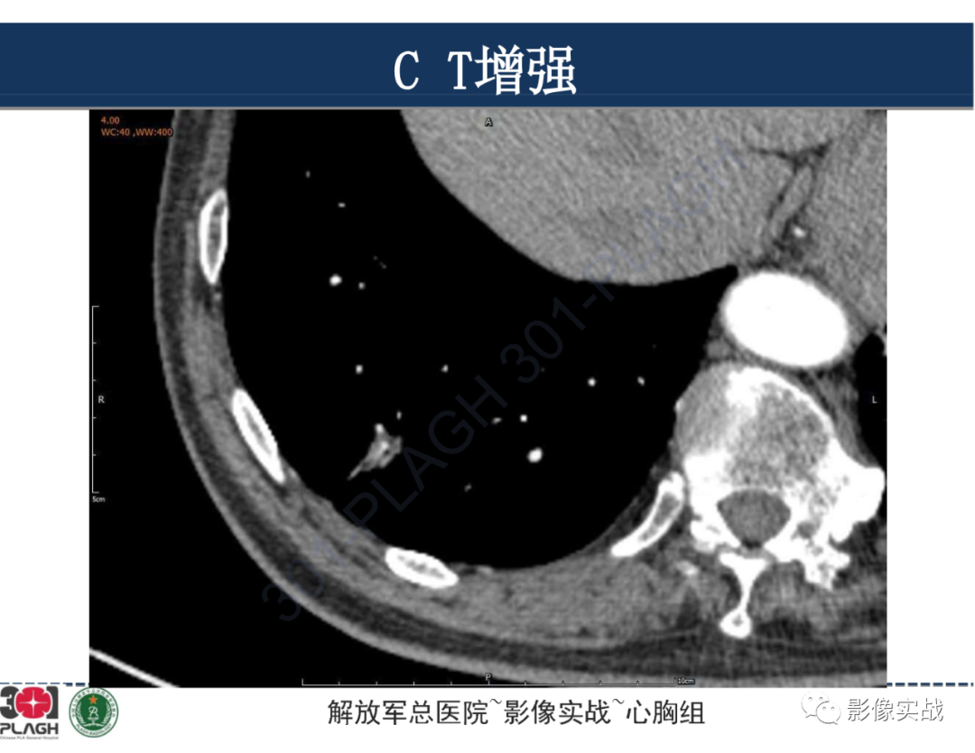 影像PPT - 【病例】肺浸润性腺癌1例CT影像-20