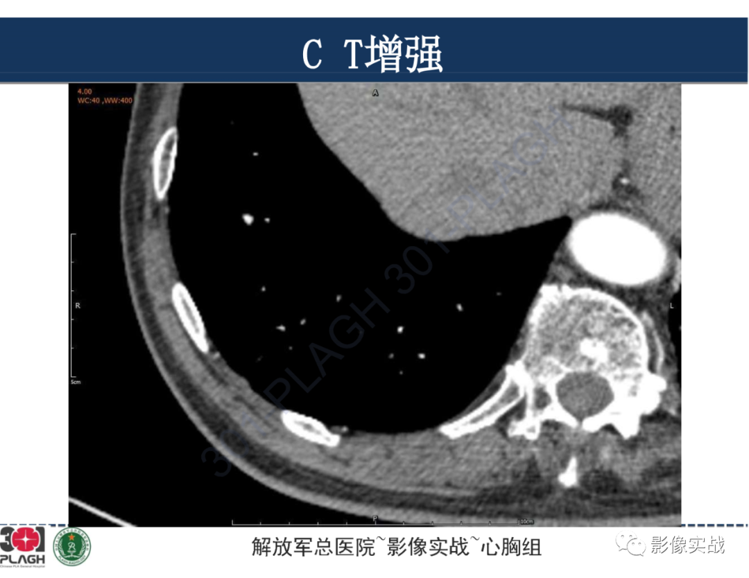 影像PPT - 【病例】肺浸润性腺癌1例CT影像-21