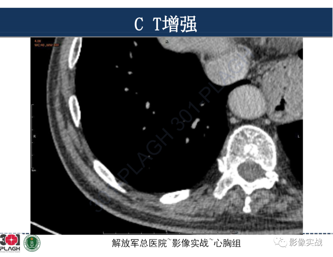 影像PPT - 【病例】肺浸润性腺癌1例CT影像-22