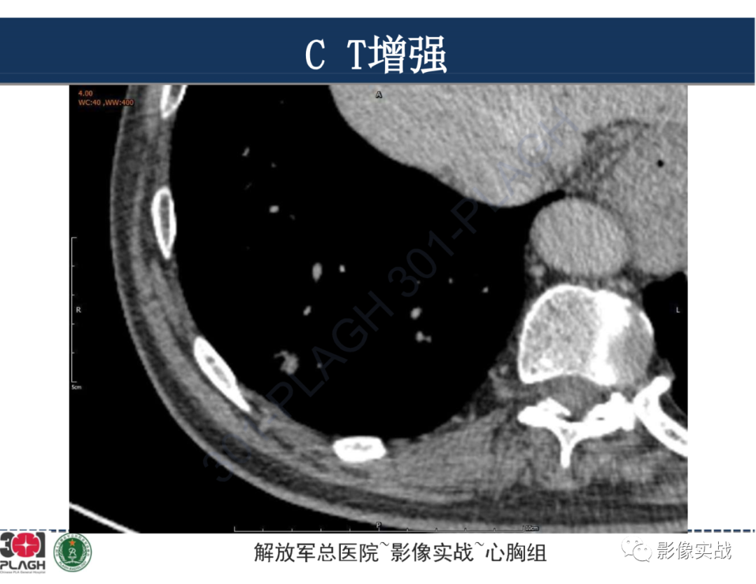 影像PPT - 【病例】肺浸润性腺癌1例CT影像-23