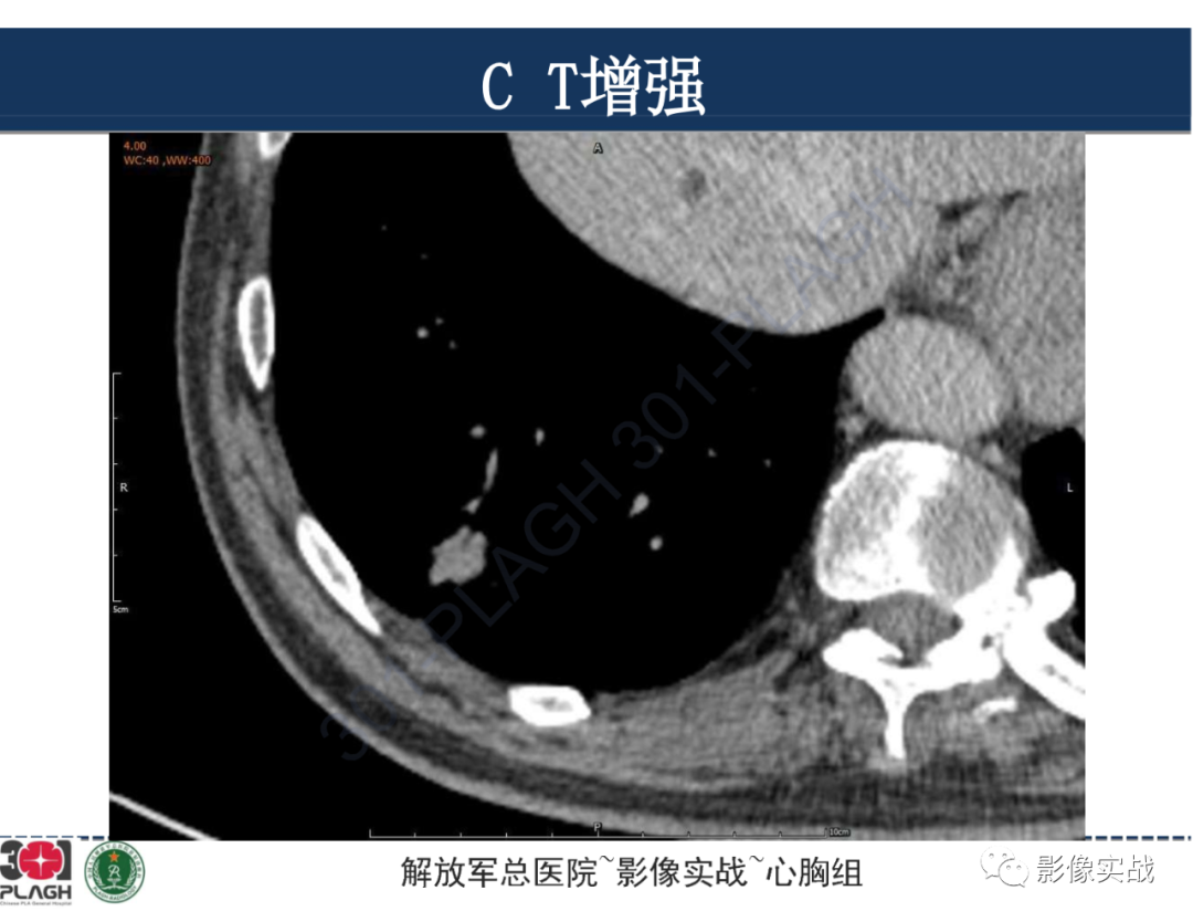 影像PPT - 【病例】肺浸润性腺癌1例CT影像-24