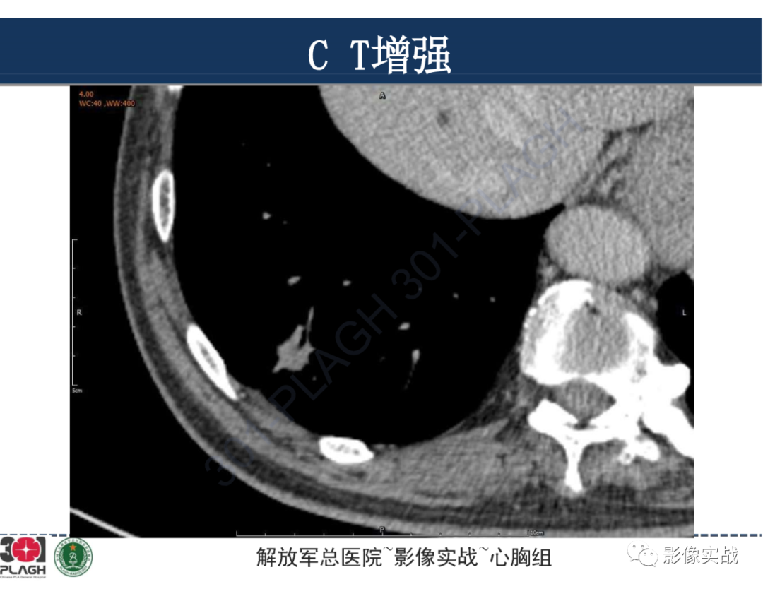 影像PPT - 【病例】肺浸润性腺癌1例CT影像-25