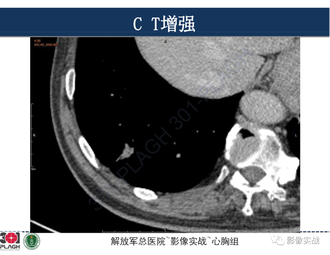 影像PPT - 【病例】肺浸润性腺癌1例CT影像-26