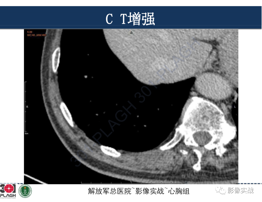 影像PPT - 【病例】肺浸润性腺癌1例CT影像-27
