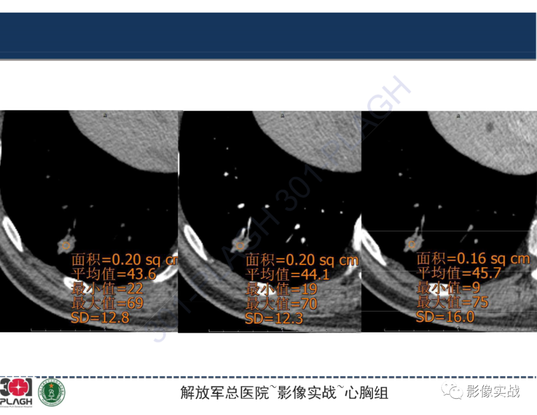 影像PPT - 【病例】肺浸润性腺癌1例CT影像-28
