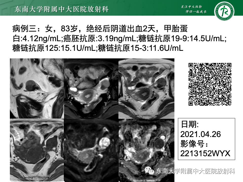 影像PPT - 【PPT】附件区弥散受限占位随访-5