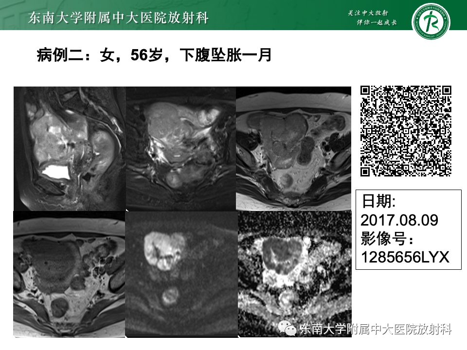 影像PPT - 【PPT】附件区弥散受限占位随访-9