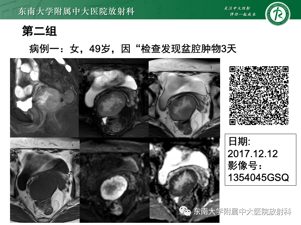 影像PPT - 【PPT】附件区弥散受限占位随访-7