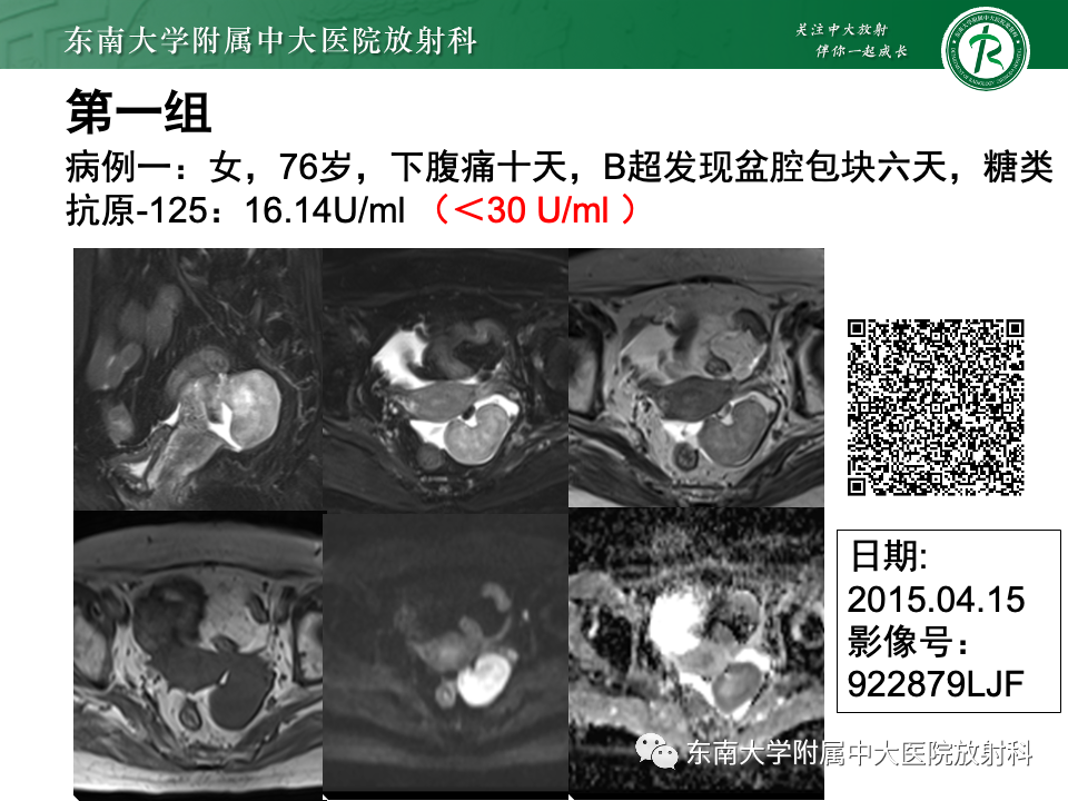 影像PPT - 【PPT】附件区弥散受限占位随访-1