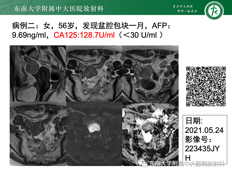 影像PPT - 【PPT】附件区弥散受限占位随访-3