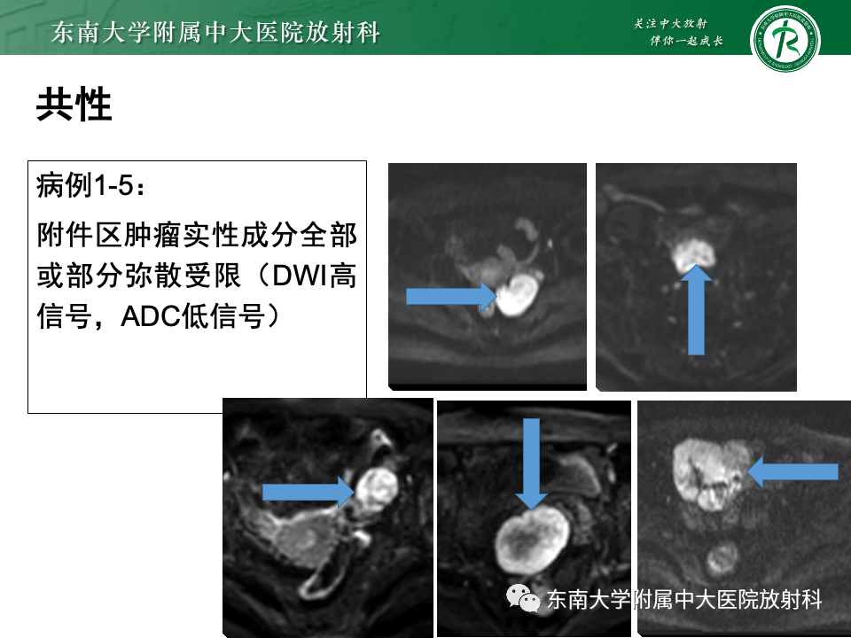 影像PPT - 【PPT】附件区弥散受限占位随访-14