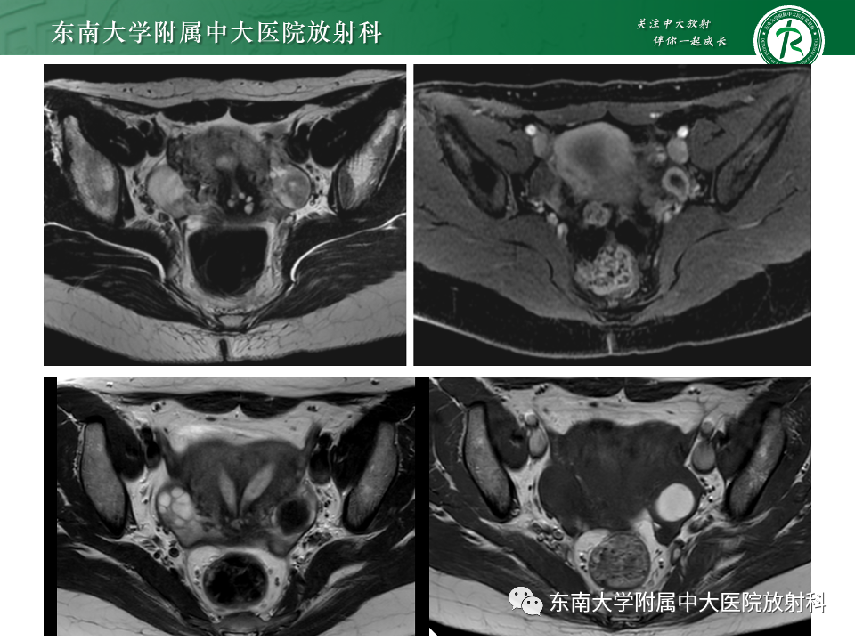 影像PPT - 【PPT】附件区弥散受限占位随访-20
