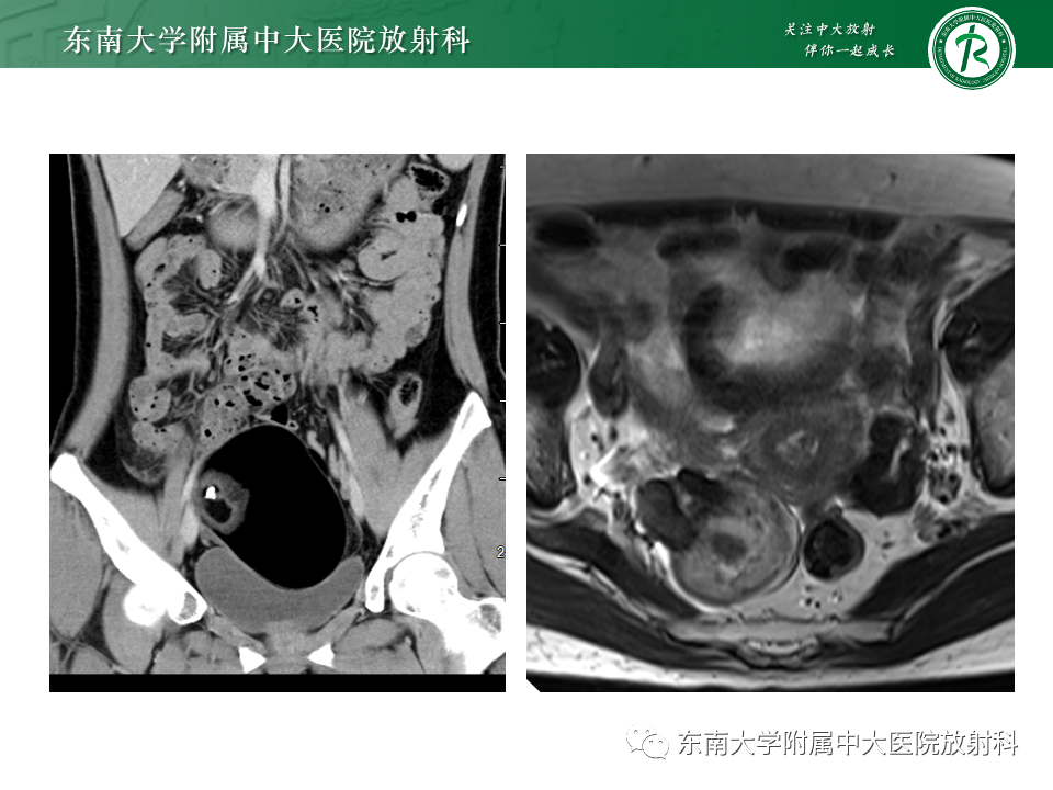 影像PPT - 【PPT】附件区弥散受限占位随访-23