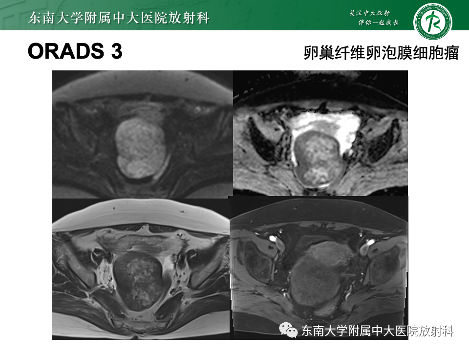 影像PPT - 【PPT】附件区弥散受限占位随访-30