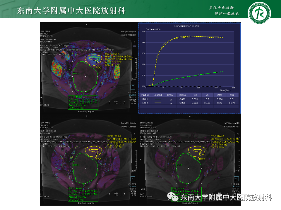 影像PPT - 【PPT】附件区弥散受限占位随访-29