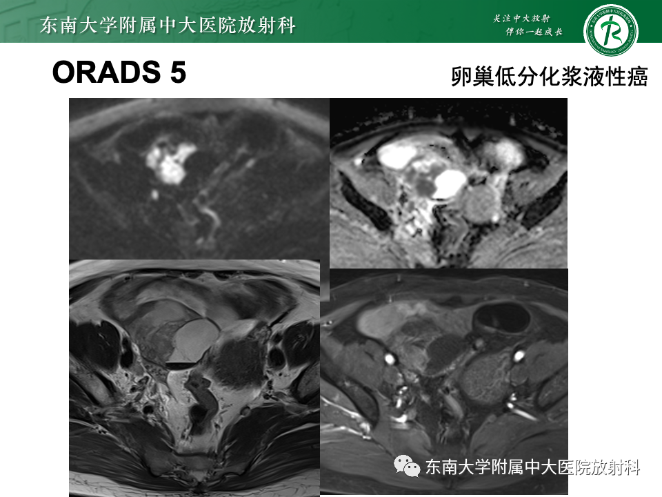 影像PPT - 【PPT】附件区弥散受限占位随访-32