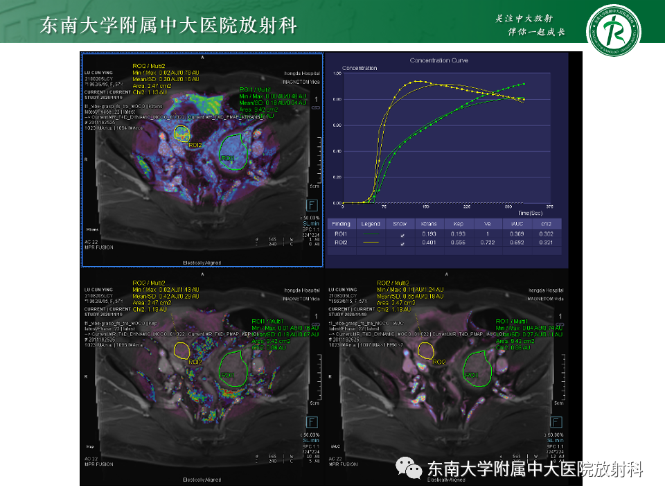 影像PPT - 【PPT】附件区弥散受限占位随访-31