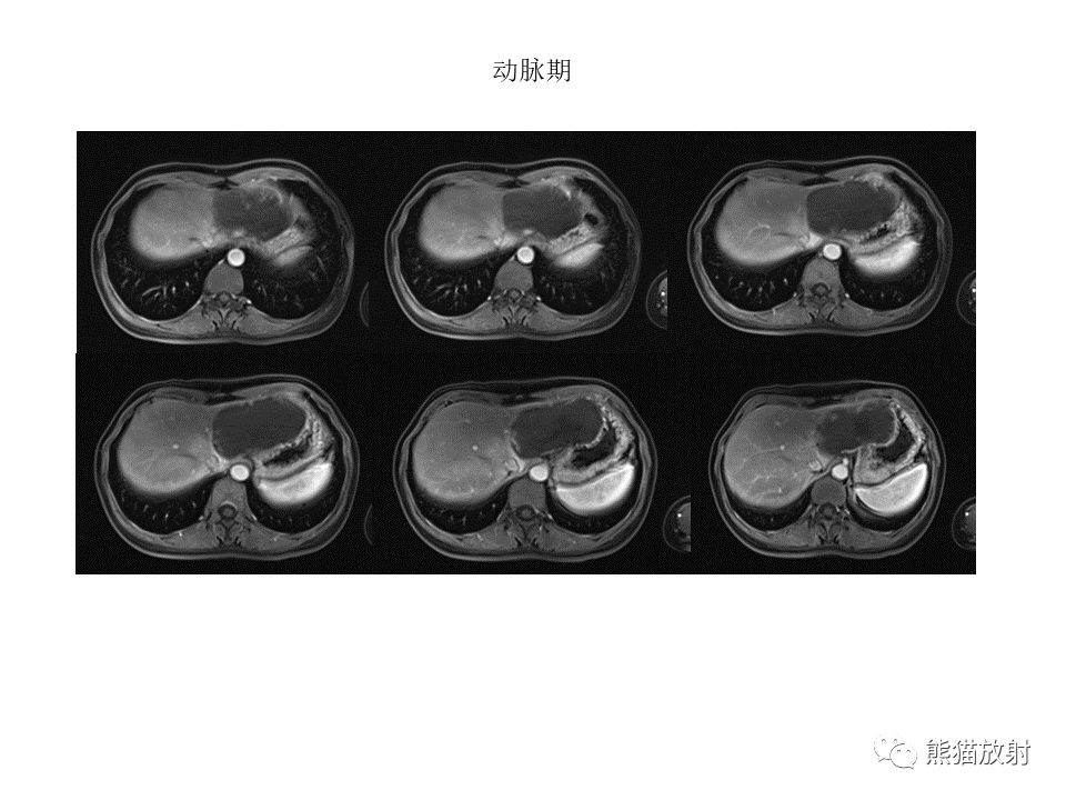 影像PPT - 【病例】肝上皮样血管内皮瘤 VS 海绵状血管瘤-19