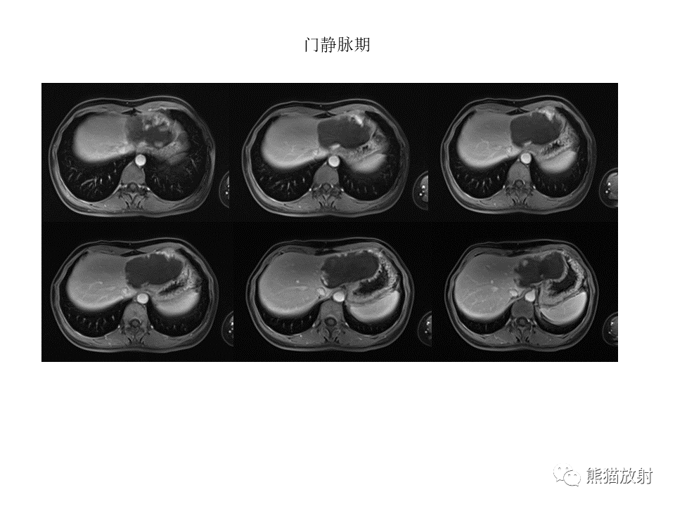 影像PPT - 【病例】肝上皮样血管内皮瘤 VS 海绵状血管瘤-20