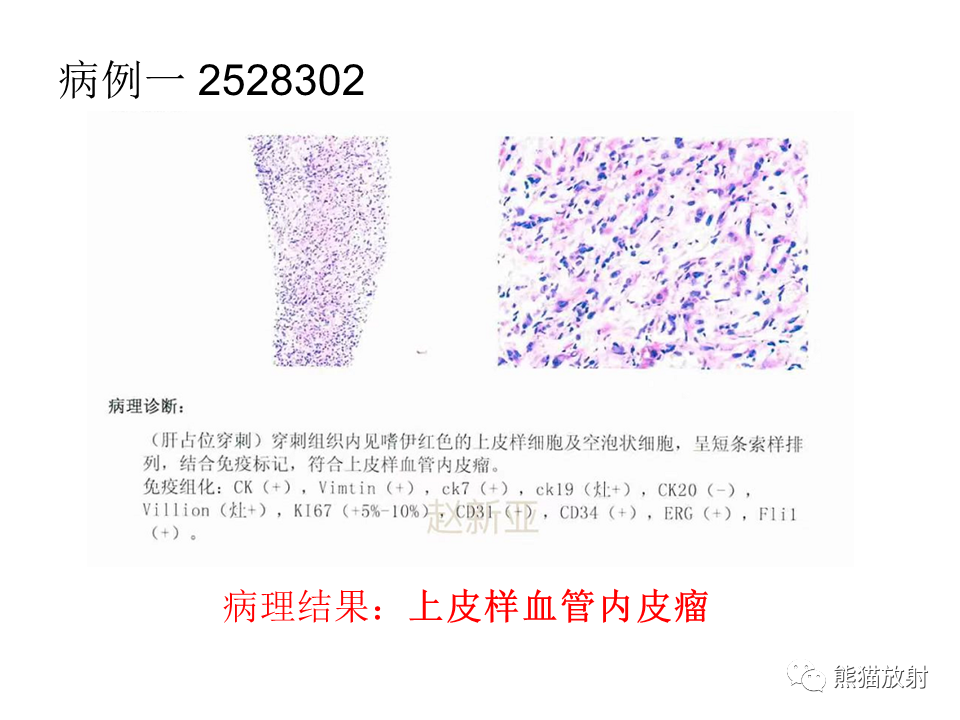 影像PPT - 【病例】肝上皮样血管内皮瘤 VS 海绵状血管瘤-27