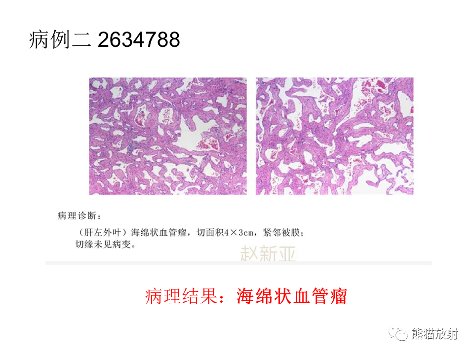 影像PPT - 【病例】肝上皮样血管内皮瘤 VS 海绵状血管瘤-28