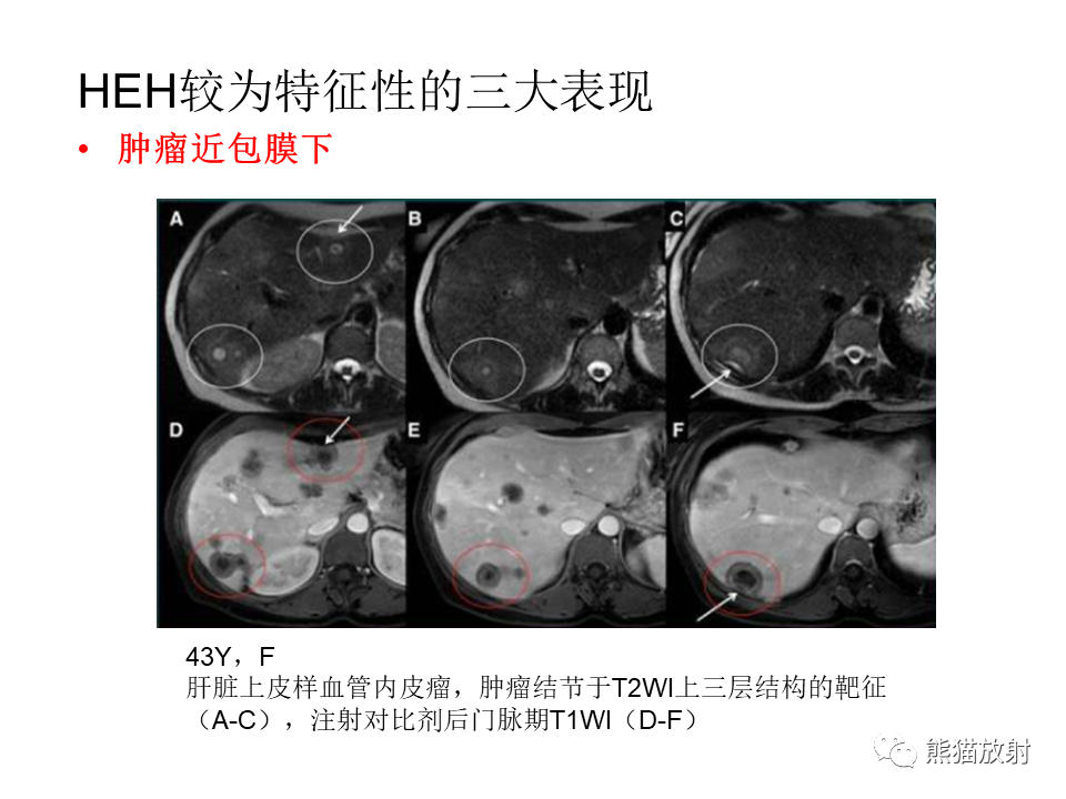 影像PPT - 【病例】肝上皮样血管内皮瘤 VS 海绵状血管瘤-32