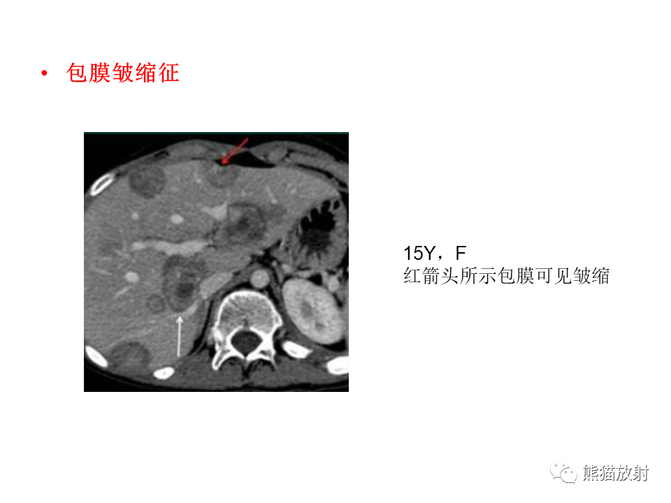 影像PPT - 【病例】肝上皮样血管内皮瘤 VS 海绵状血管瘤-33