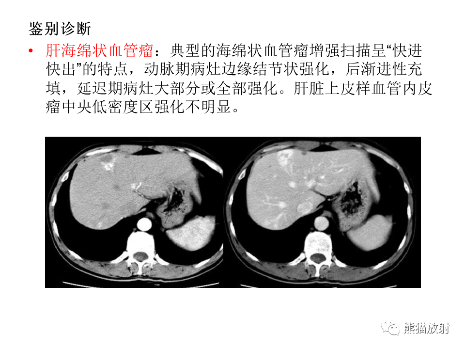 影像PPT - 【病例】肝上皮样血管内皮瘤 VS 海绵状血管瘤-35