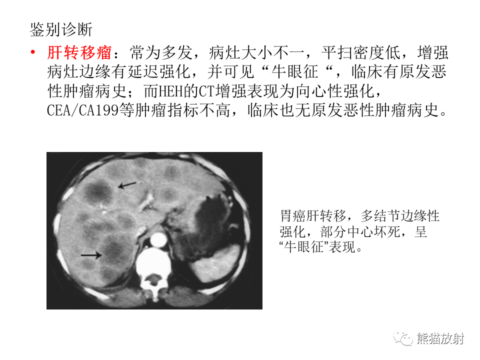 影像PPT - 【病例】肝上皮样血管内皮瘤 VS 海绵状血管瘤-36