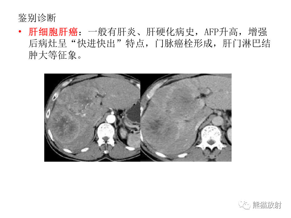 影像PPT - 【病例】肝上皮样血管内皮瘤 VS 海绵状血管瘤-38