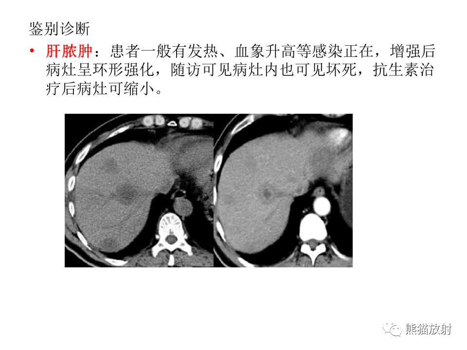 影像PPT - 【病例】肝上皮样血管内皮瘤 VS 海绵状血管瘤-39