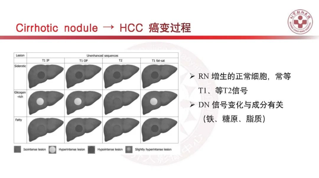 影像PPT - 【PPT】HCC诊断及鉴别诊断-25