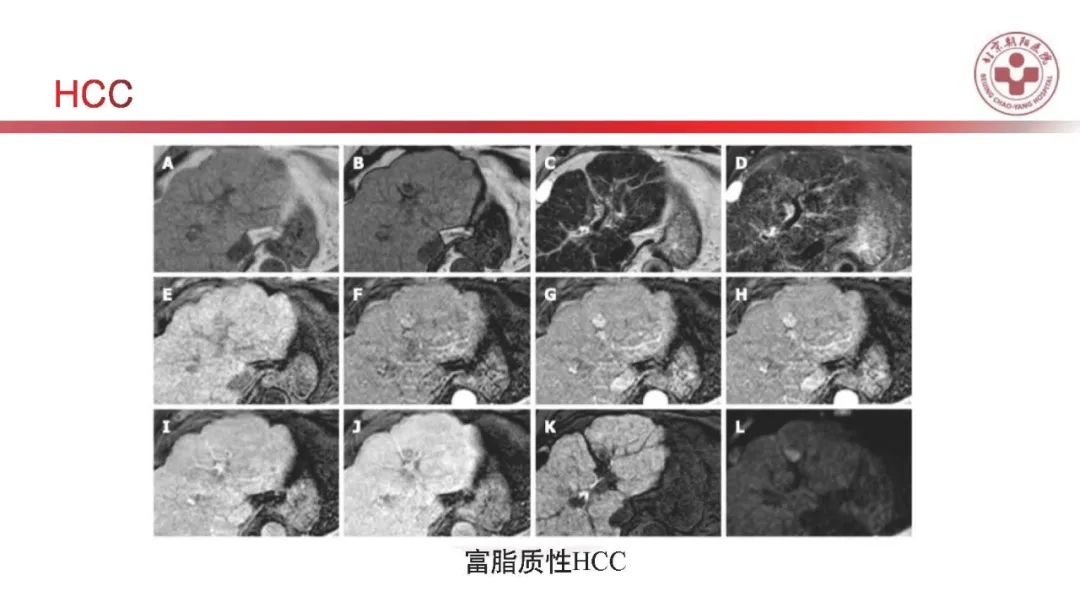 影像PPT - 【PPT】HCC诊断及鉴别诊断-28