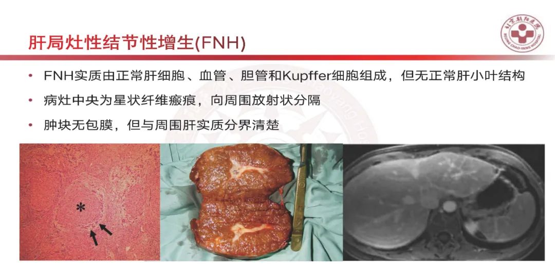 影像PPT - 【PPT】HCC诊断及鉴别诊断-39