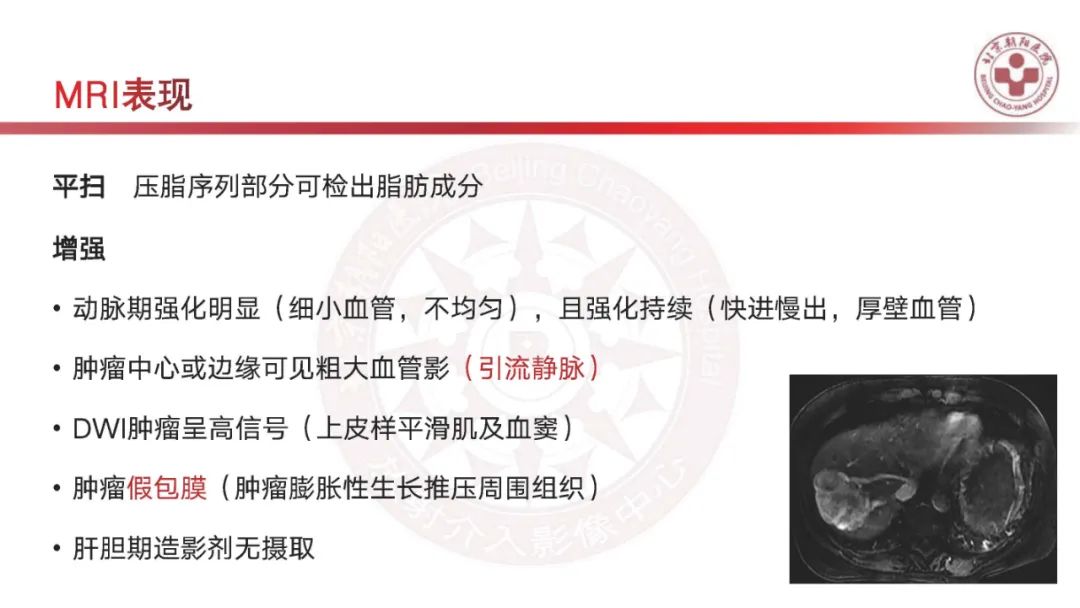 影像PPT - 【PPT】HCC诊断及鉴别诊断-43