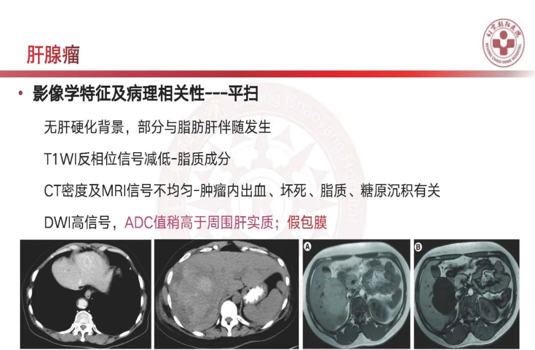 影像PPT - 【PPT】HCC诊断及鉴别诊断-47