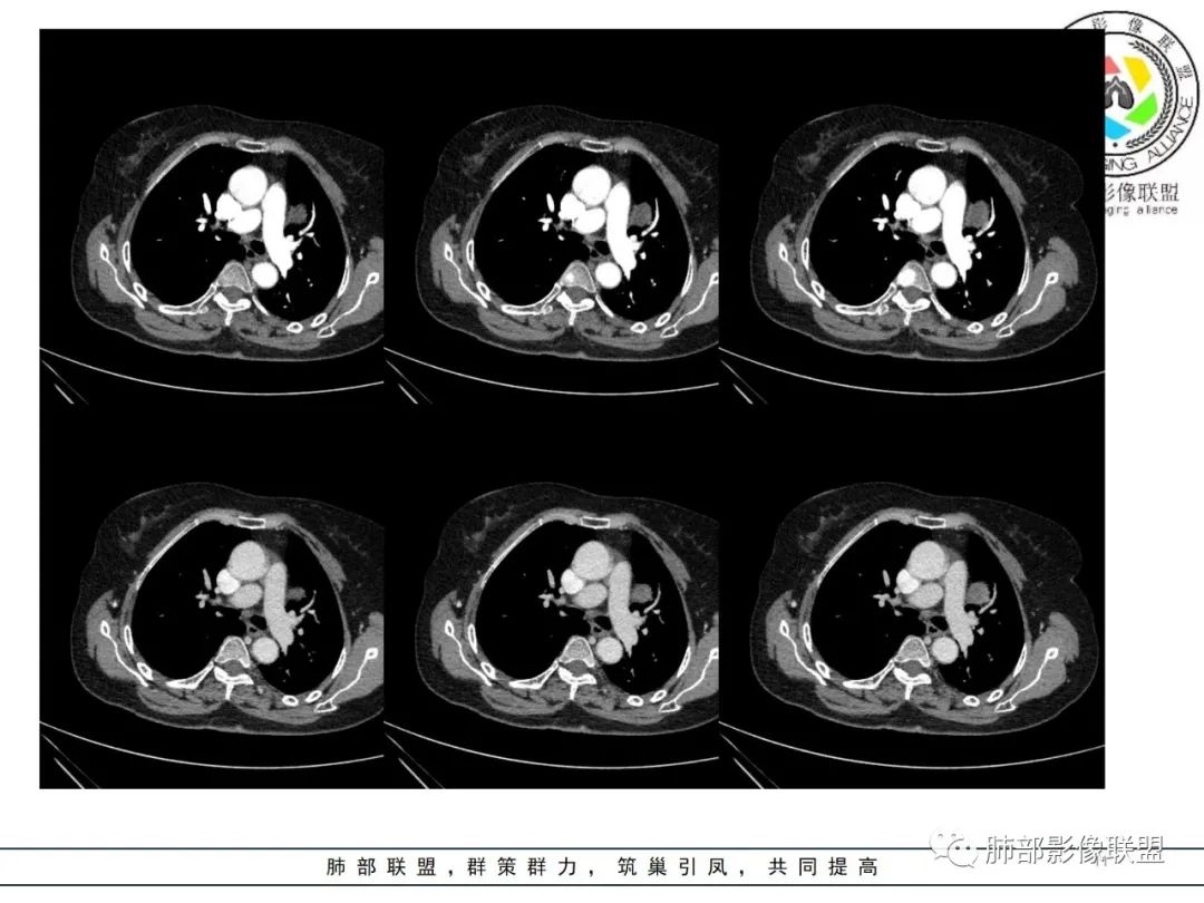 影像PPT - 【病例】肺内孤立性纤维瘤1例CT影像诊断要点-11 影像PPT - 【病例】肺内孤立性纤维瘤1例CT影像诊断要点-11