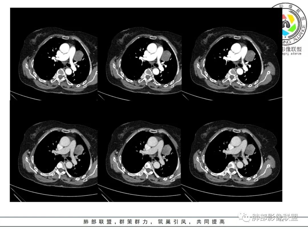 影像PPT - 【病例】肺内孤立性纤维瘤1例CT影像诊断要点-14 影像PPT - 【病例】肺内孤立性纤维瘤1例CT影像诊断要点-14