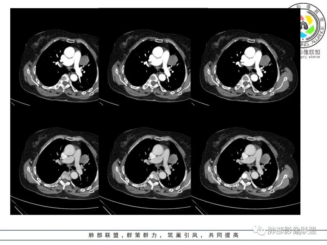 影像PPT - 【病例】肺内孤立性纤维瘤1例CT影像诊断要点-13 影像PPT - 【病例】肺内孤立性纤维瘤1例CT影像诊断要点-13