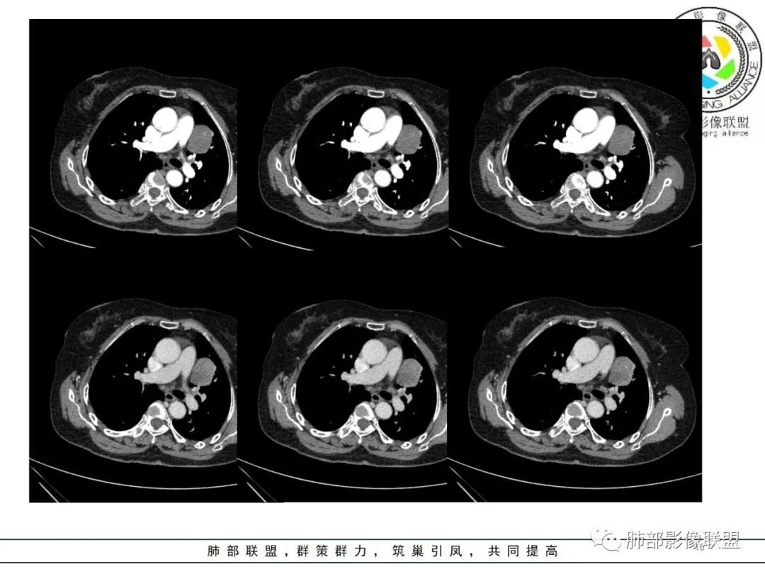 影像PPT - 【病例】肺内孤立性纤维瘤1例CT影像诊断要点-15 影像PPT - 【病例】肺内孤立性纤维瘤1例CT影像诊断要点-15