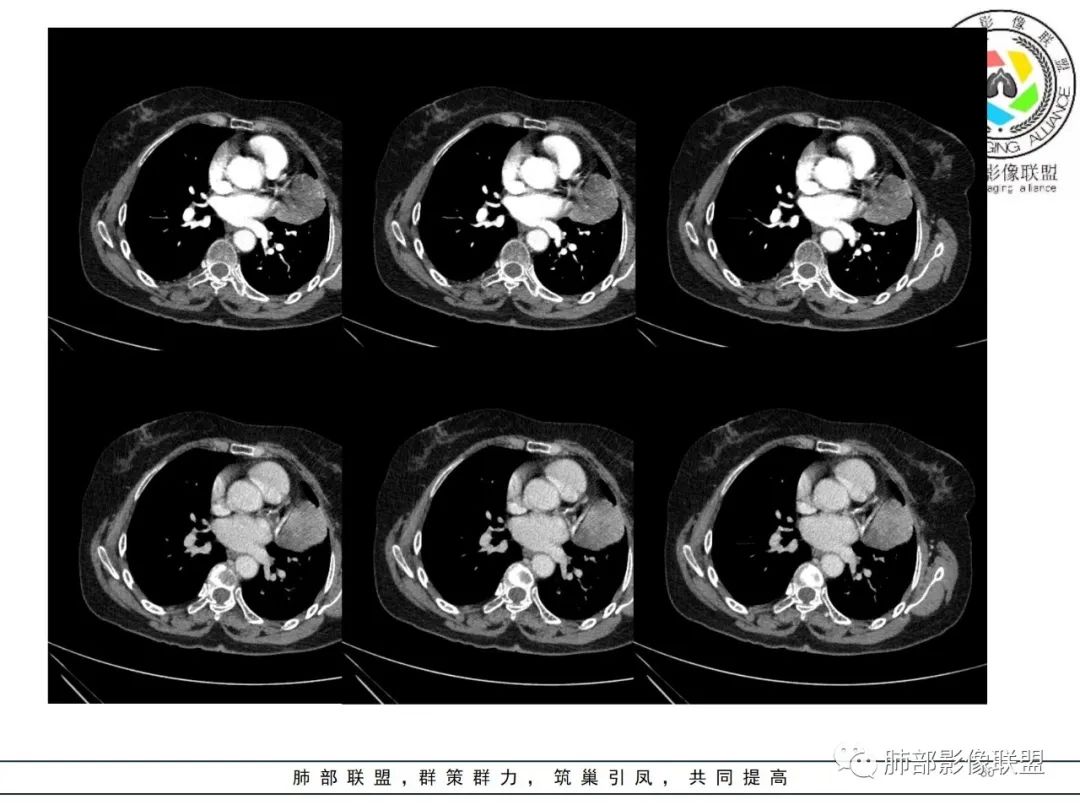 影像PPT - 【病例】肺内孤立性纤维瘤1例CT影像诊断要点-30 影像PPT - 【病例】肺内孤立性纤维瘤1例CT影像诊断要点-30