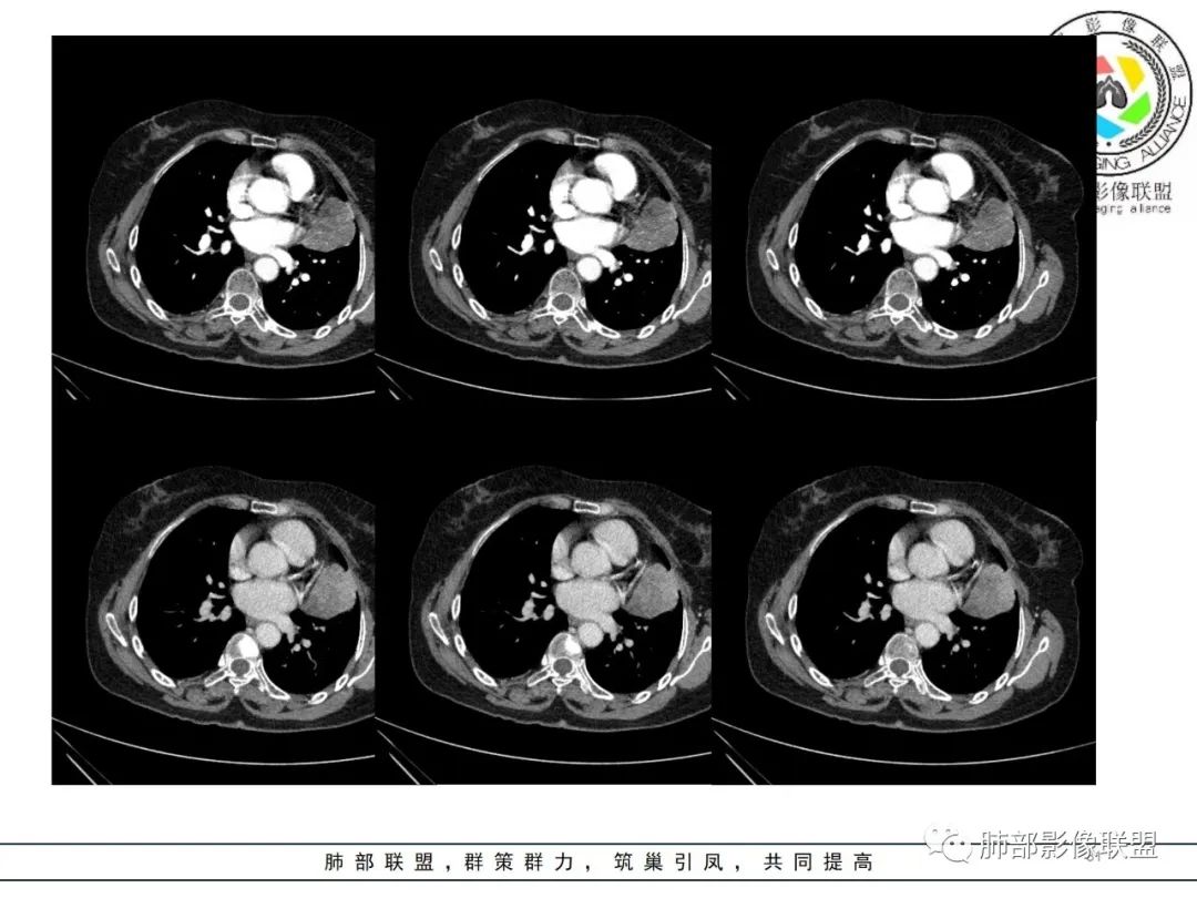 影像PPT - 【病例】肺内孤立性纤维瘤1例CT影像诊断要点-31 影像PPT - 【病例】肺内孤立性纤维瘤1例CT影像诊断要点-31
