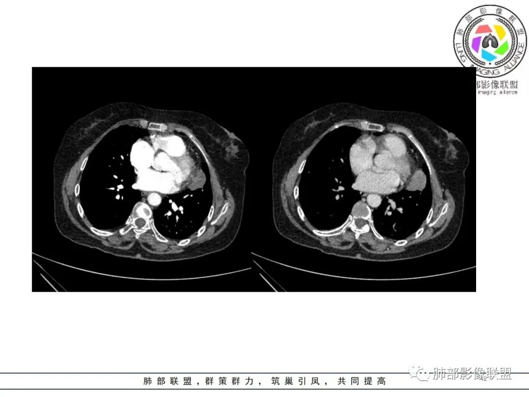 影像PPT - 【病例】肺内孤立性纤维瘤1例CT影像诊断要点-42 影像PPT - 【病例】肺内孤立性纤维瘤1例CT影像诊断要点-42